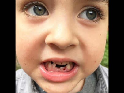 3rd tooth out!
